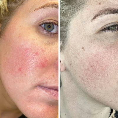 ACNE BOOT CAMP